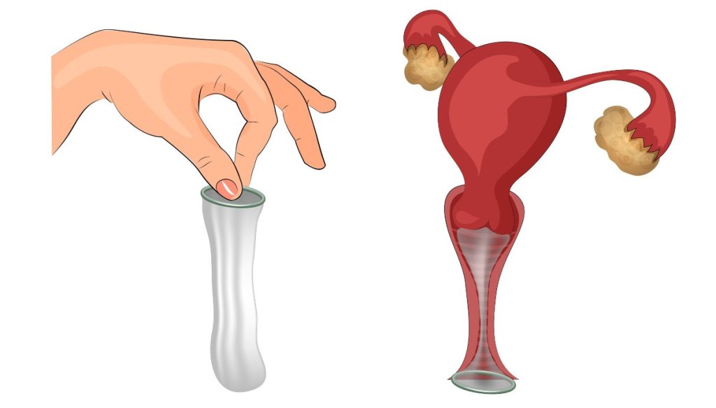 preservativo femminile