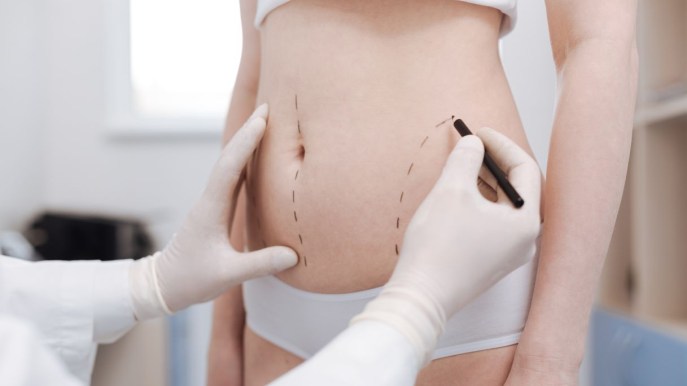 Liposuzione: cos’è, come funziona e possibili rischi