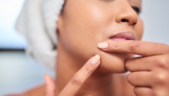 Le cause dei brufoli sul mento e i rimedi per ridurli e prevenirli