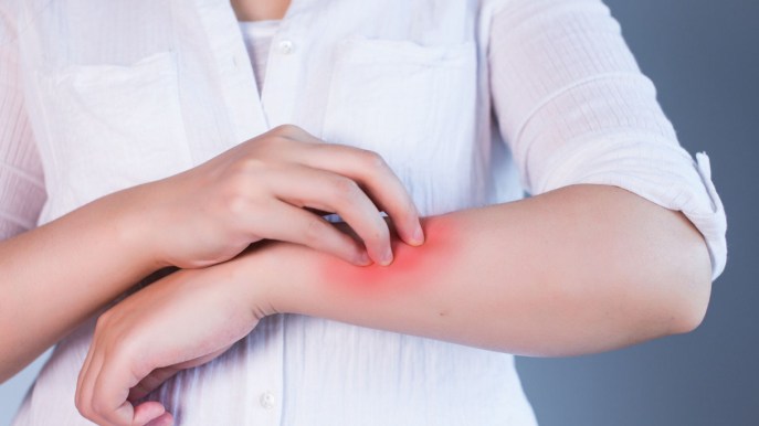 Bruciature, ecco perché il dolore rimane a lungo