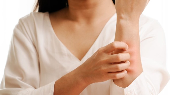Orticaria: dai sintomi ai rimedi, tutto quello che devi sapere