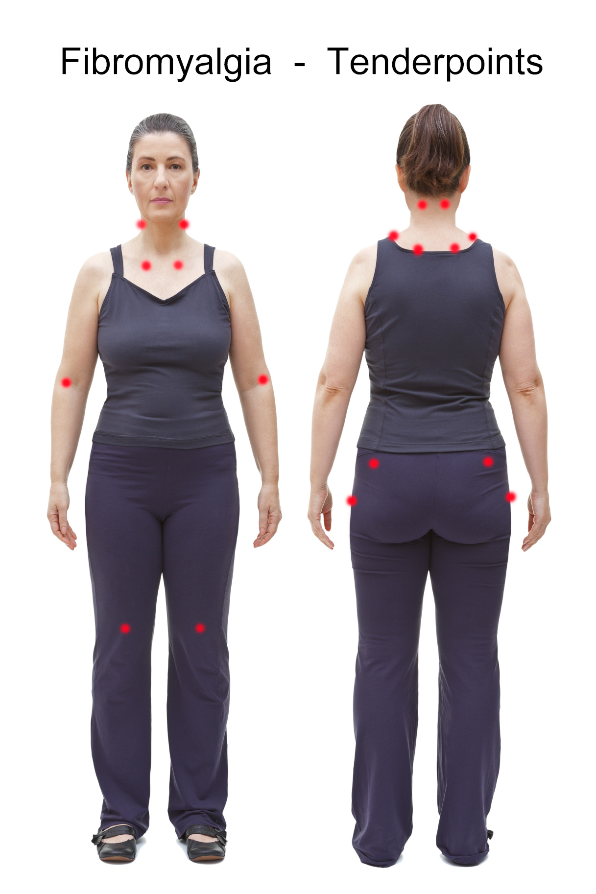 tender points fibromialgia