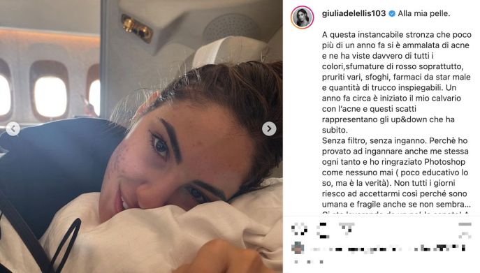 Giulia De Lellis, la lotta con l'acne