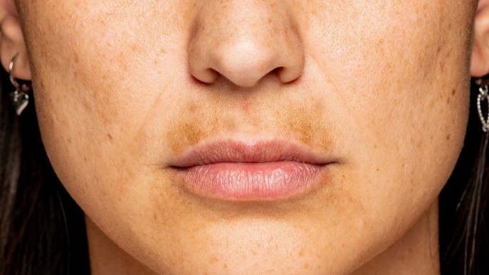 Macchie della pelle: quali rimedi naturali?