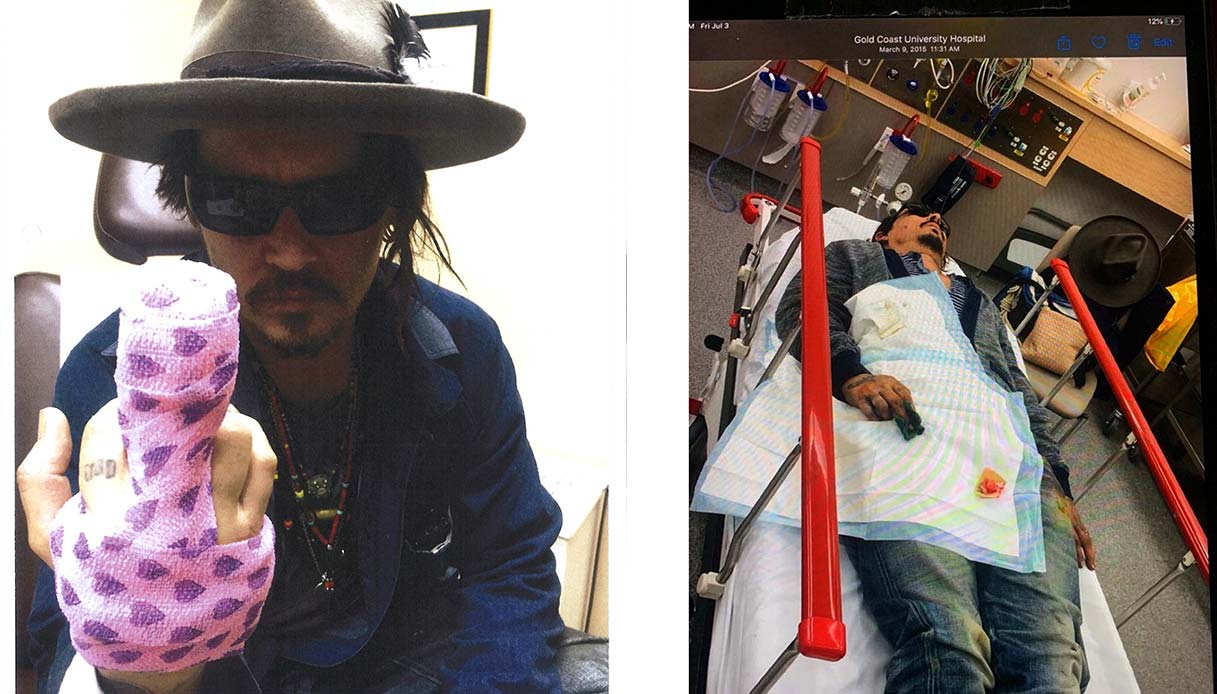 Johnny Depp mostra il dito mozzato nel corso di una lite