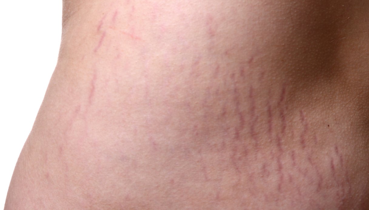 Primo piano sulla pelle di una donna caratterizzata da smagliature rosse