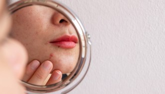 Se hai la vitiligine prendi il sole così per un’abbronzatura perfetta