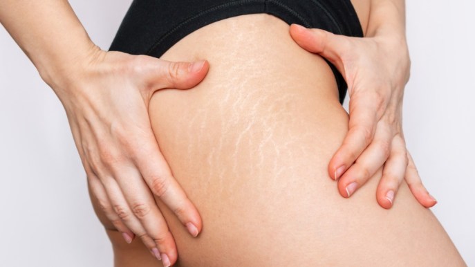 Questo olio è il trattamento antismagliature più venduto. E su Amazon è in sconto