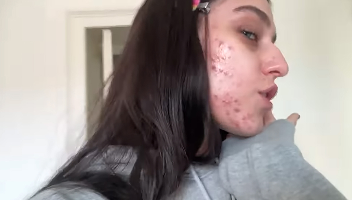 Gaia Gozzi con l'acne