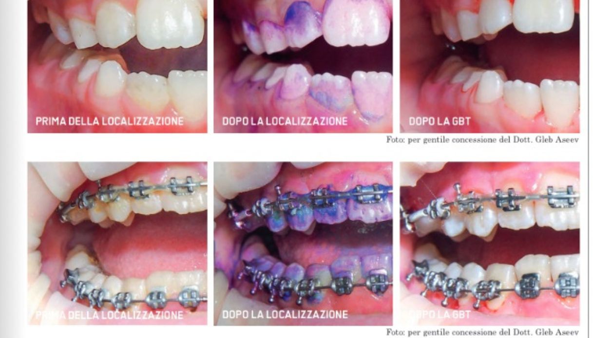 Gbt, trattamento eseguibile allo Studio Albertelli
